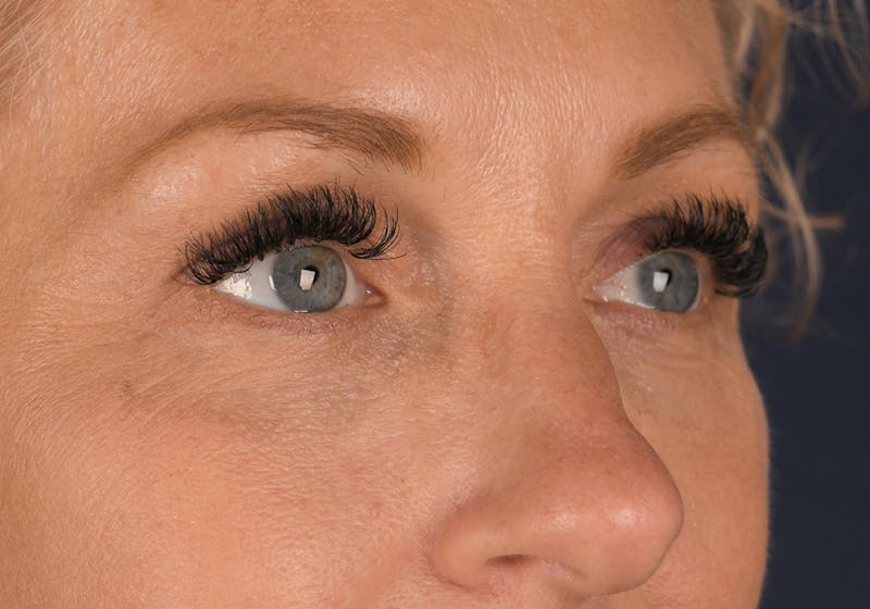 Blepharoplasty Before & After Gallery - Patient 9698246 - Image 6