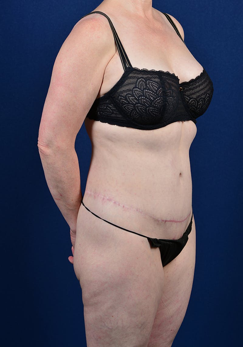Lower Body Lift Before & After Gallery - Patient 9698255 - Image 6