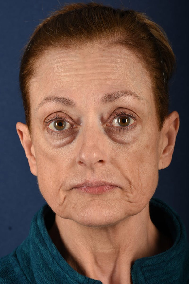 Facelift Before & After Gallery - Patient 9698256 - Image 1