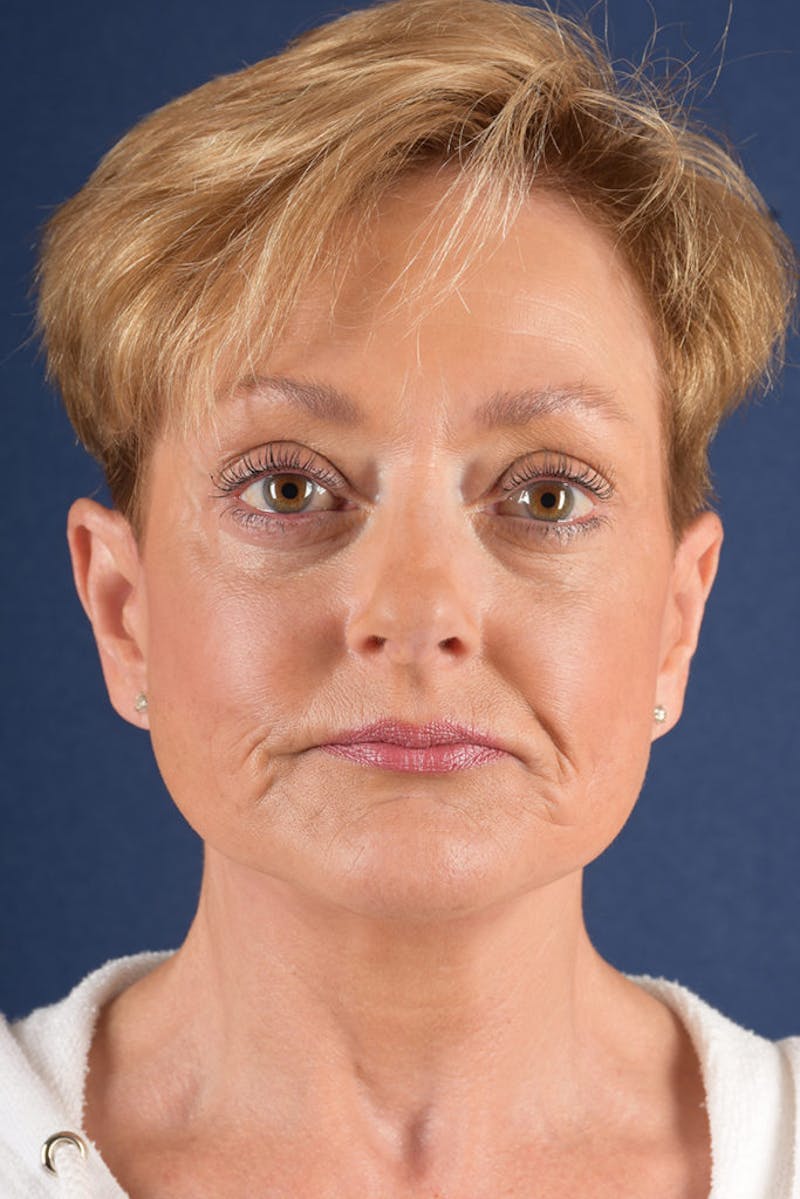 Facelift Before & After Gallery - Patient 9698256 - Image 2