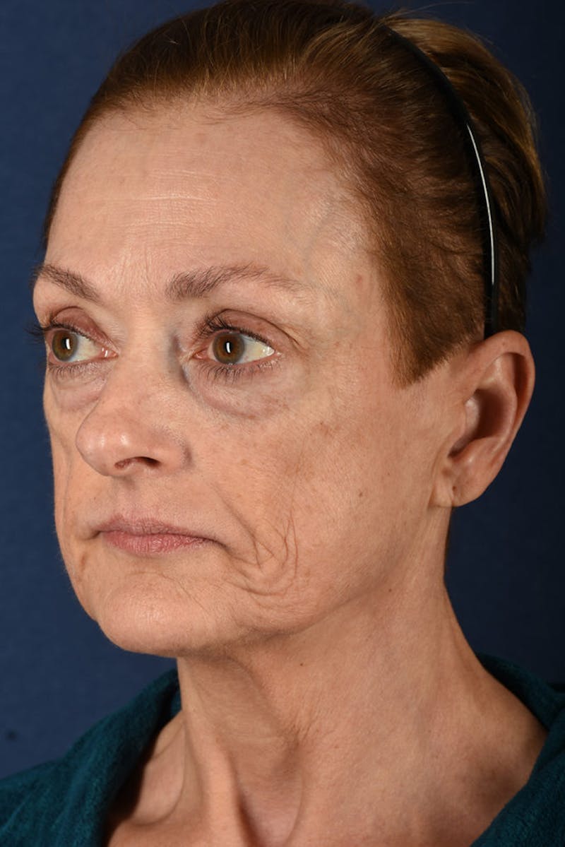 Facelift Before & After Gallery - Patient 9698256 - Image 3