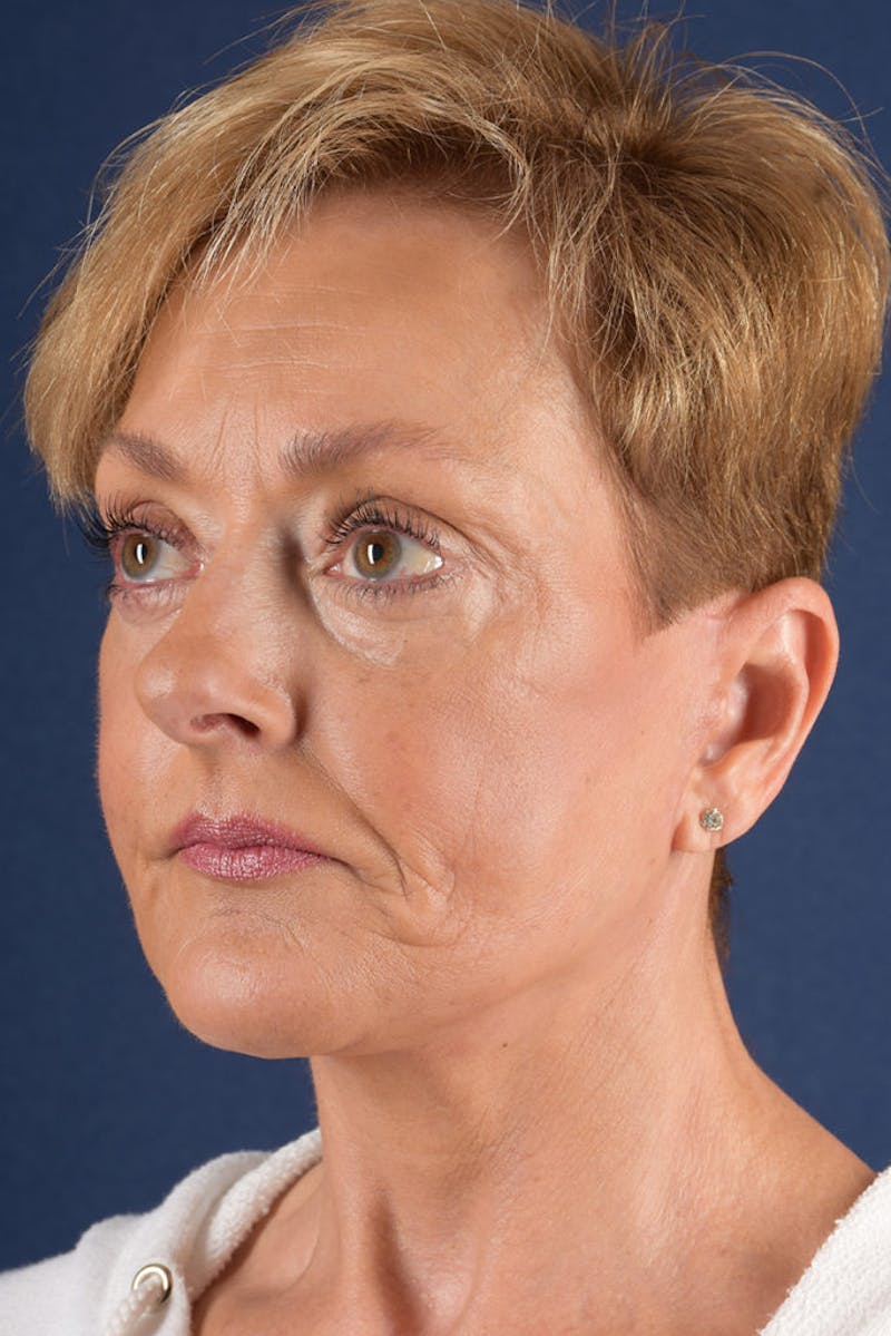 Facelift Before & After Gallery - Patient 9698256 - Image 4