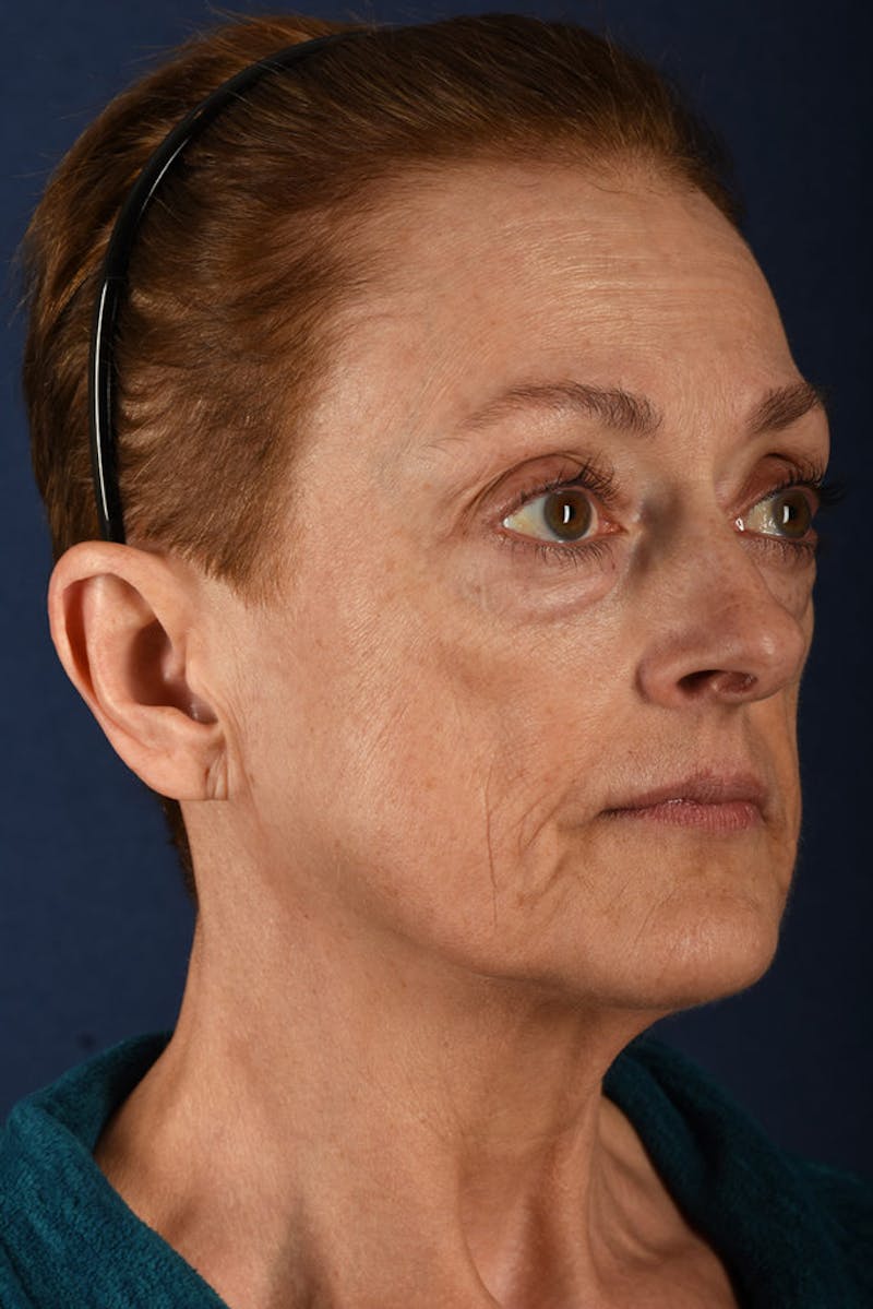 Facelift Before & After Gallery - Patient 9698256 - Image 5