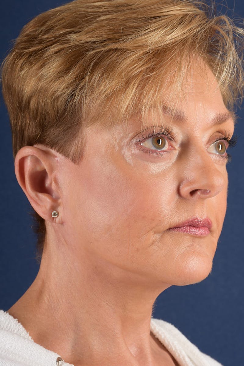 Facelift Before & After Gallery - Patient 9698256 - Image 6