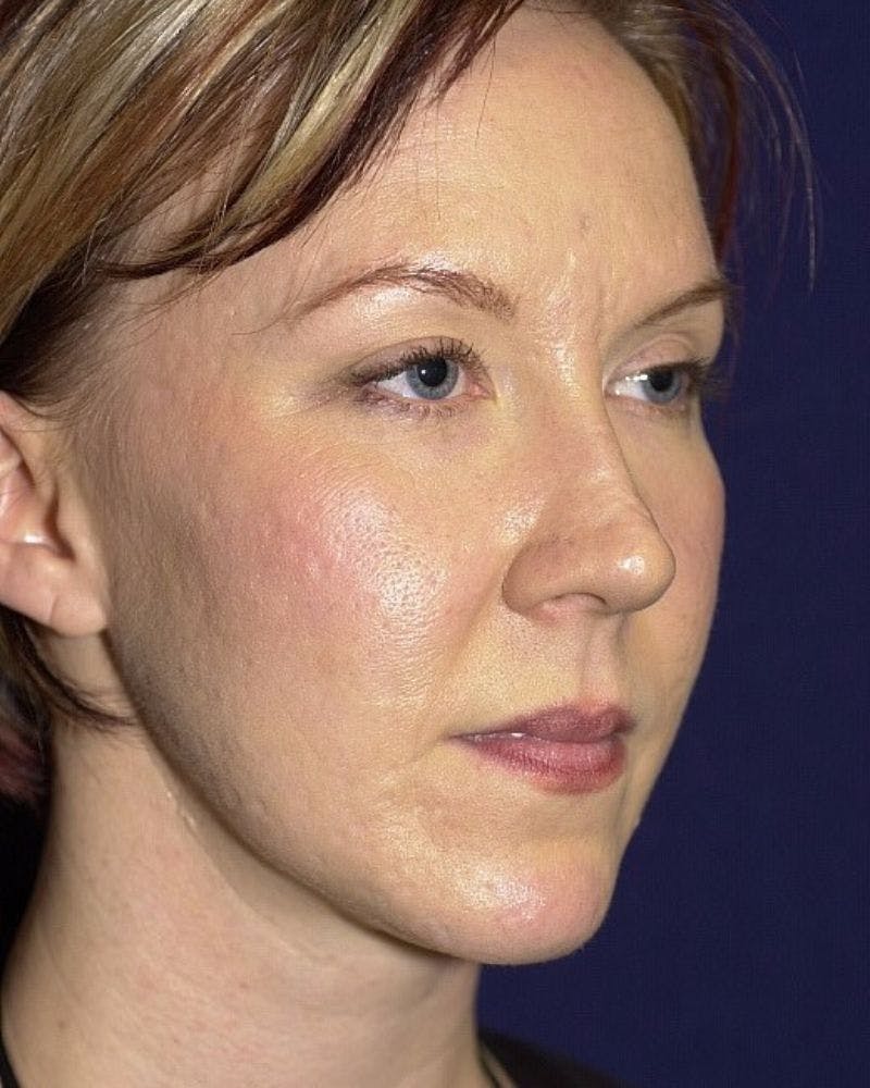 Laser Skin Resurfacing Before & After Gallery - Patient 9698310 - Image 3