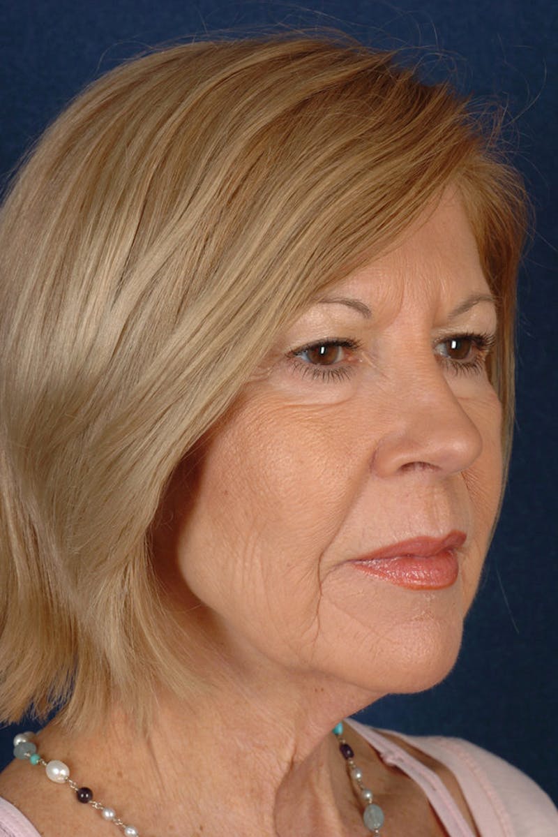Facelift Before & After Gallery - Patient 9698311 - Image 5