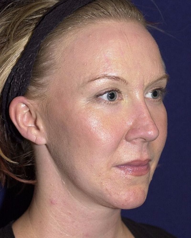 Laser Skin Resurfacing Before & After Gallery - Patient 9698310 - Image 4