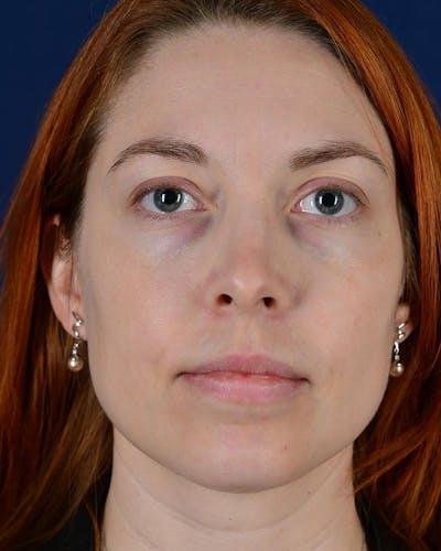 Laser Skin Resurfacing Before & After Gallery - Patient 9698314 - Image 1