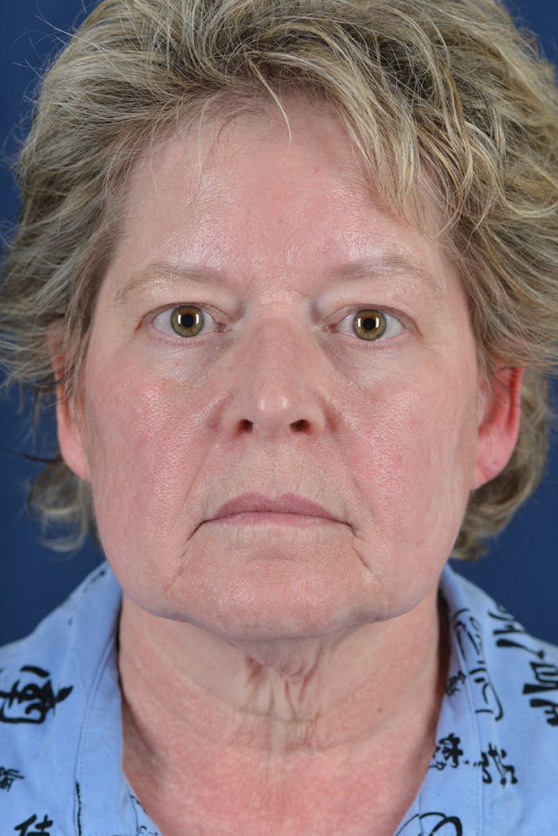 Facelift Before & After Gallery - Patient 9698315 - Image 1