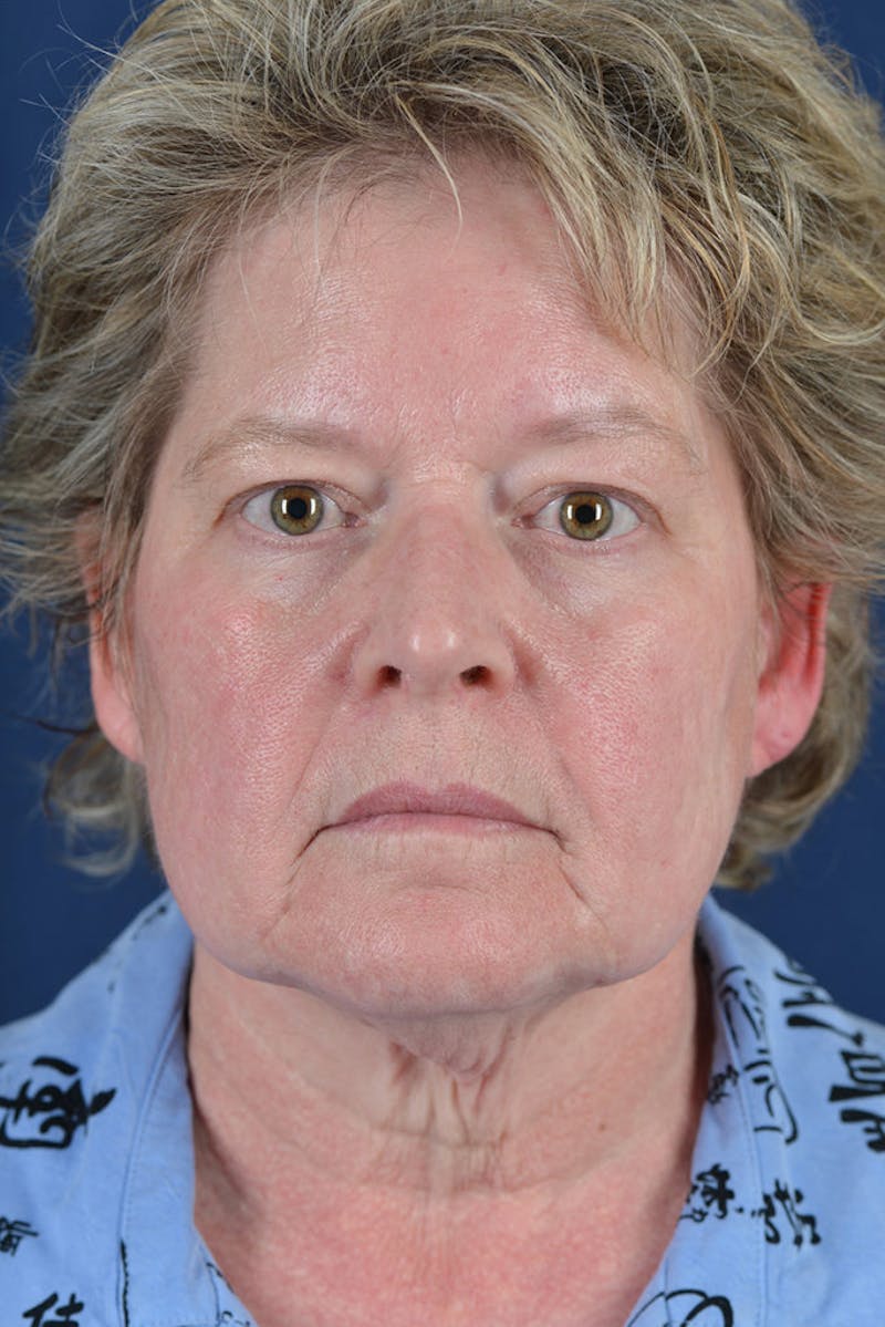 Facelift Before & After Gallery - Patient 9698315 - Image 1