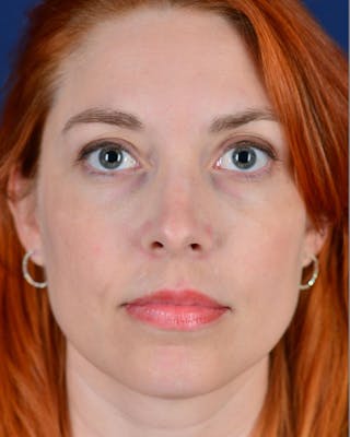 Laser Skin Resurfacing Before & After Gallery - Patient 9698314 - Image 2