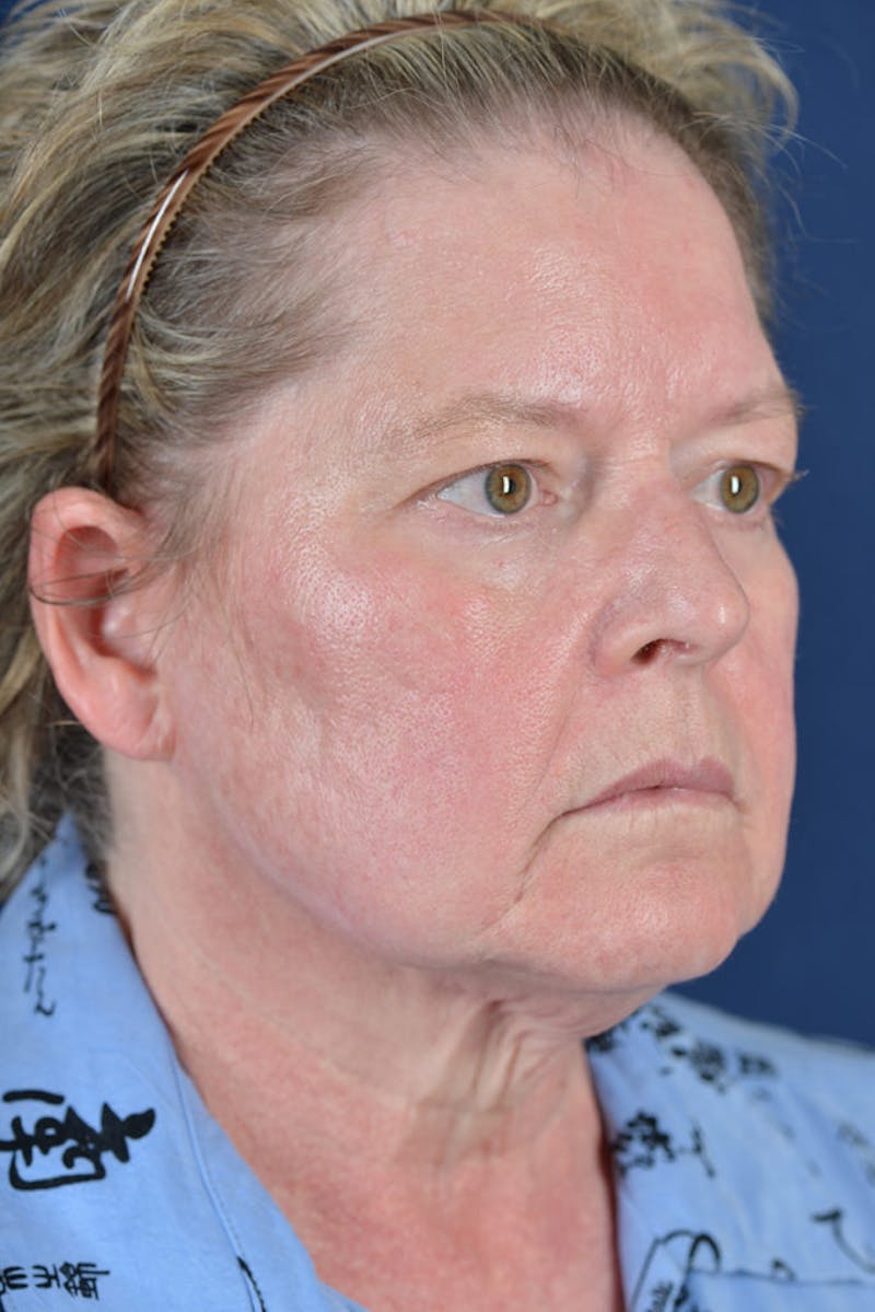 Facelift Before & After Gallery - Patient 9698315 - Image 5