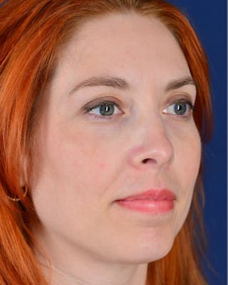 Laser Skin Resurfacing Before & After Gallery - Patient 9698314 - Image 6