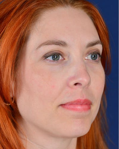 Laser Skin Resurfacing Before & After Gallery - Patient 9698314 - Image 6