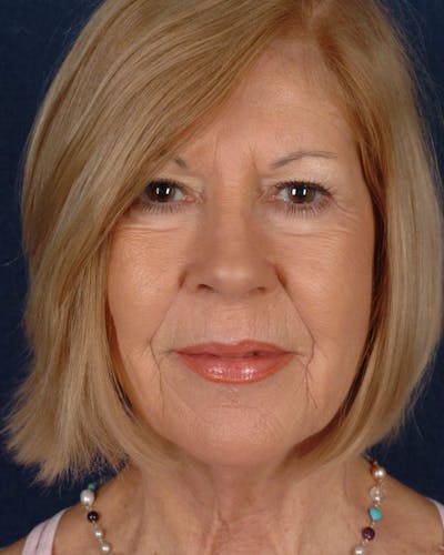 Laser Skin Resurfacing Before & After Gallery - Patient 9698316 - Image 1