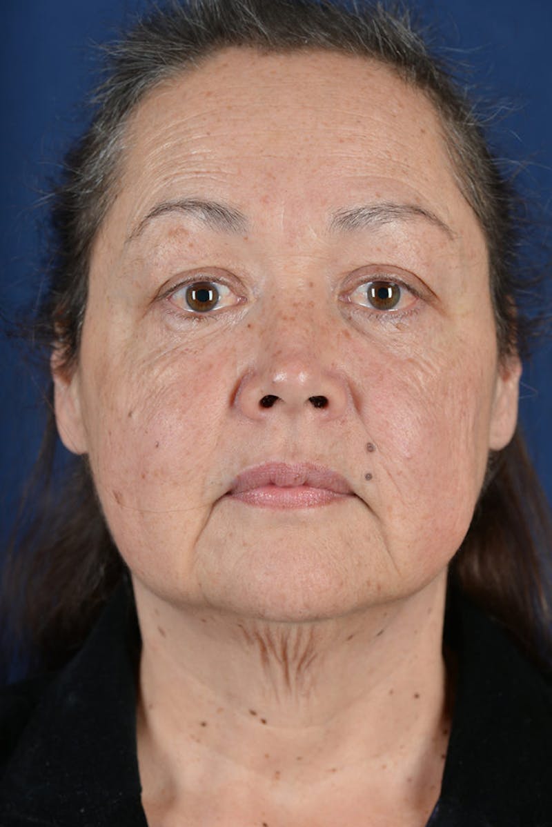 Facelift Before & After Gallery - Patient 9698319 - Image 1