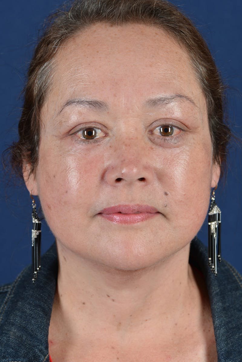 Facelift Before & After Gallery - Patient 9698319 - Image 2