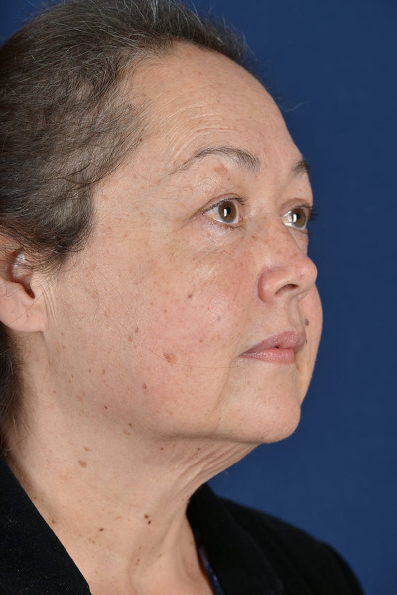 Facelift Before & After Gallery - Patient 9698319 - Image 3