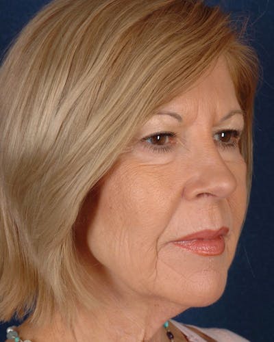 Laser Skin Resurfacing Before & After Gallery - Patient 9698316 - Image 5