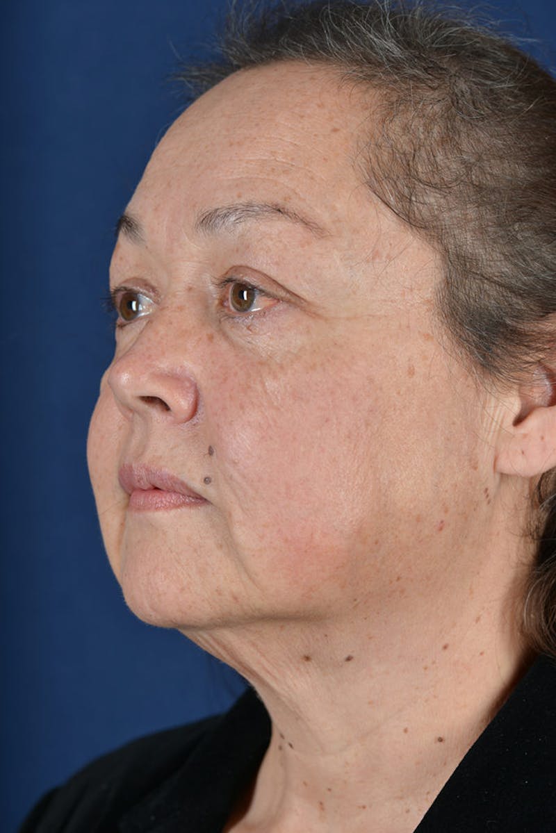 Facelift Before & After Gallery - Patient 9698319 - Image 5
