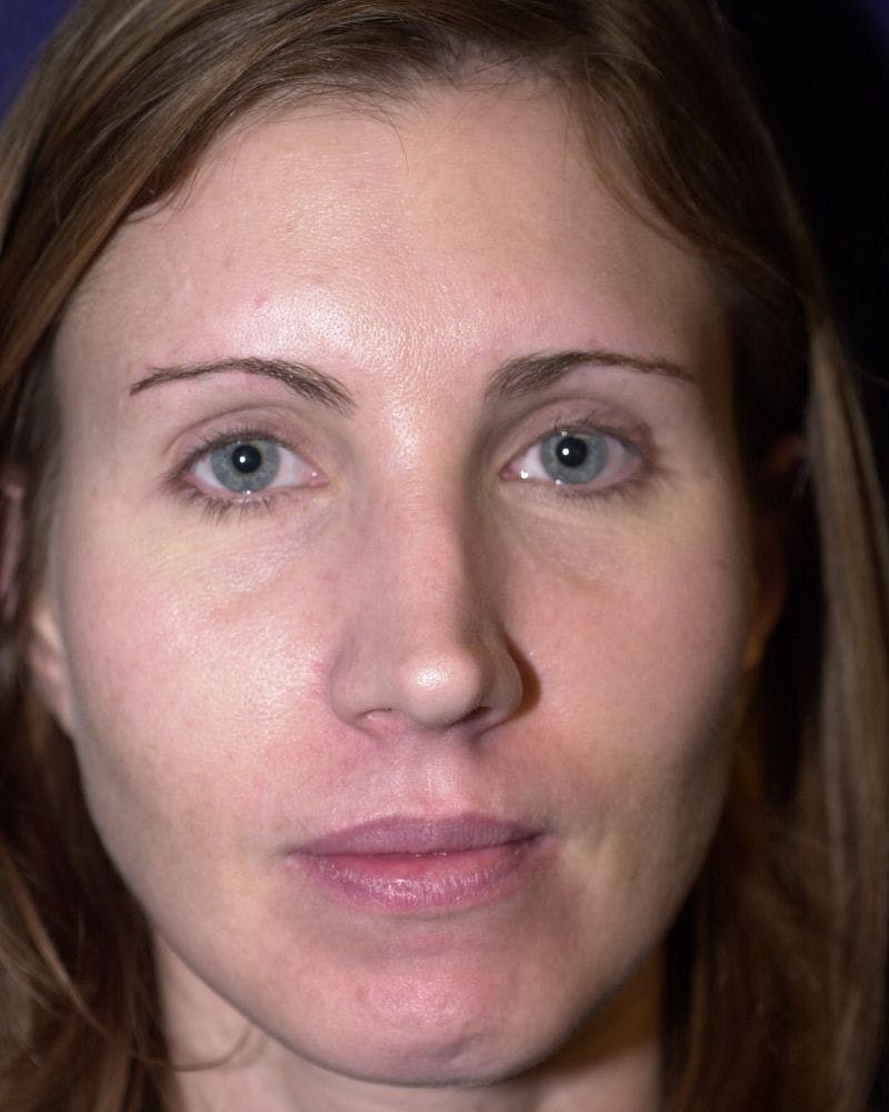 Laser Skin Resurfacing Before & After Gallery - Patient 9698322 - Image 1