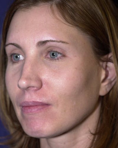 Laser Skin Resurfacing Before & After Gallery - Patient 9698322 - Image 3