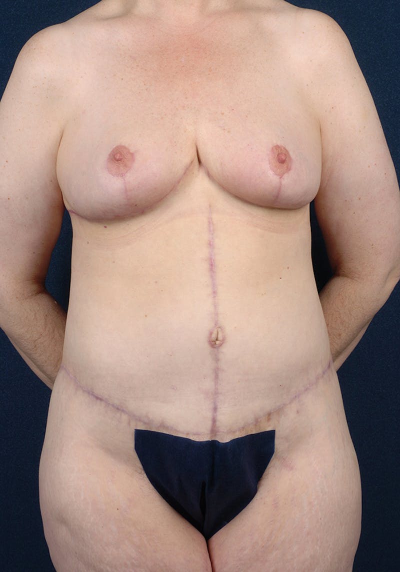 Lower Body Lift Before & After Gallery - Patient 9698325 - Image 2