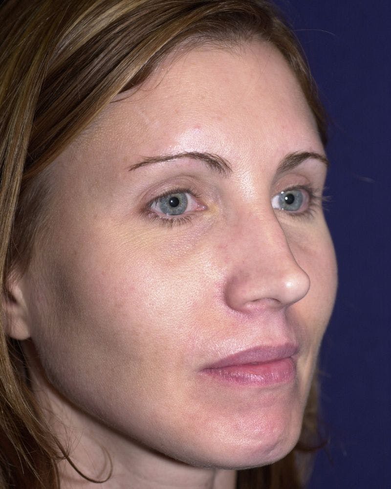 Laser Skin Resurfacing Before & After Gallery - Patient 9698322 - Image 5