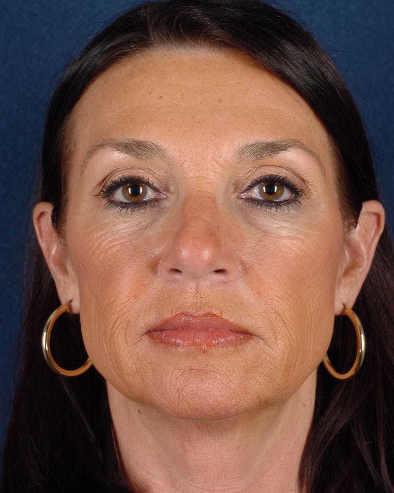 Laser Skin Resurfacing Before & After Gallery - Patient 9698326 - Image 1