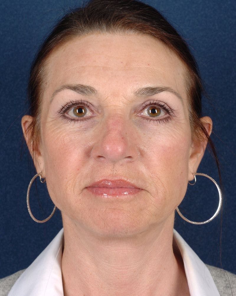 Laser Skin Resurfacing Before & After Gallery - Patient 9698326 - Image 2