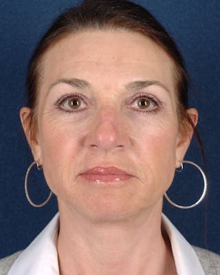 Laser Skin Resurfacing Before & After Gallery - Patient 9698326 - Image 2