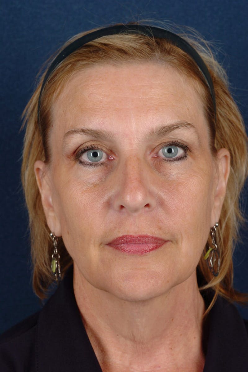 Facelift Before & After Gallery - Patient 9698327 - Image 1