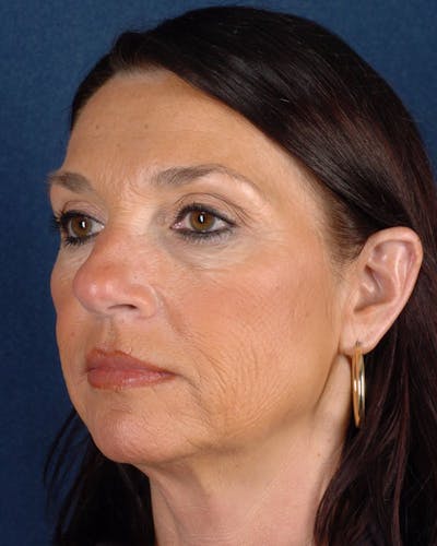 Laser Skin Resurfacing Before & After Gallery - Patient 9698326 - Image 3