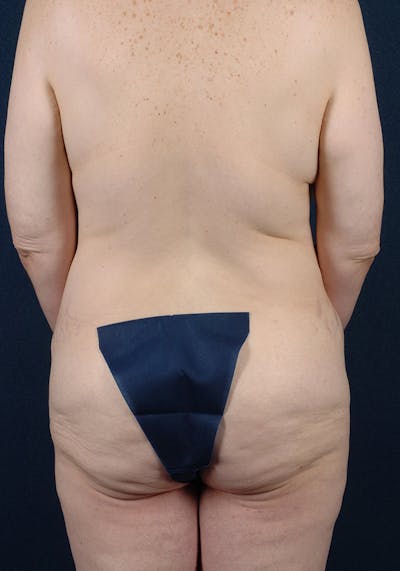 Lower Body Lift Before & After Gallery - Patient 9698325 - Image 7