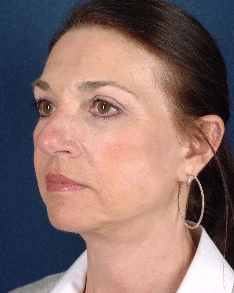 Laser Skin Resurfacing Before & After Gallery - Patient 9698326 - Image 4