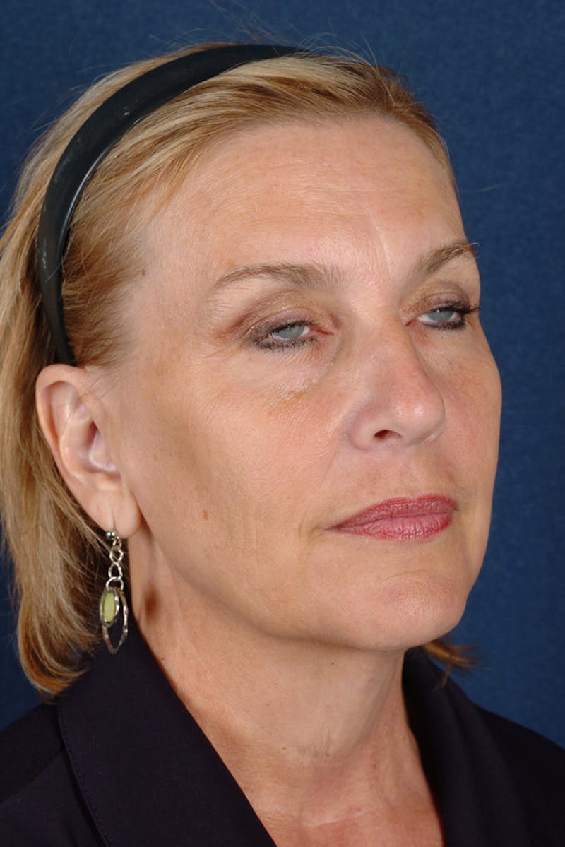 Facelift Before & After Gallery - Patient 9698327 - Image 5
