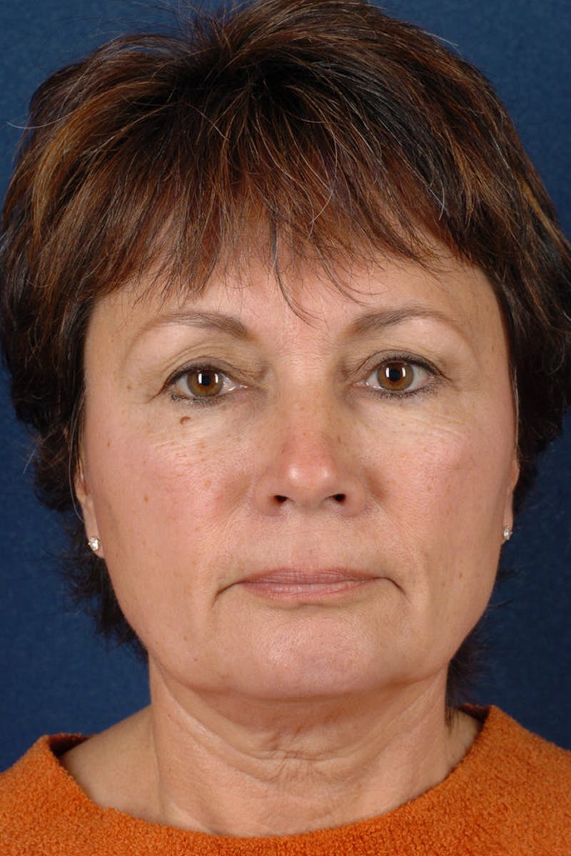 Facelift Before & After Gallery - Patient 9698331 - Image 1