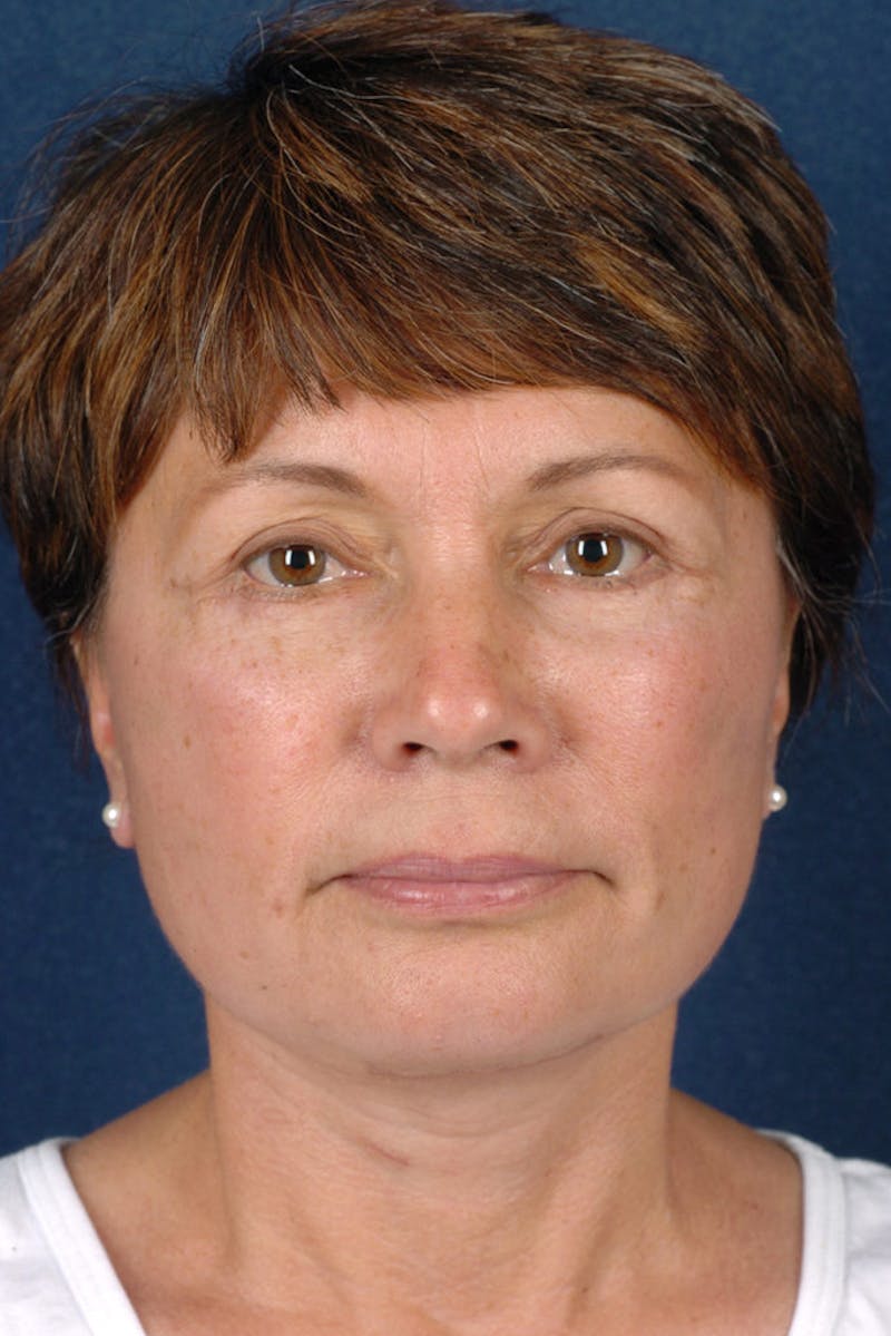 Facelift Before & After Gallery - Patient 9698331 - Image 2