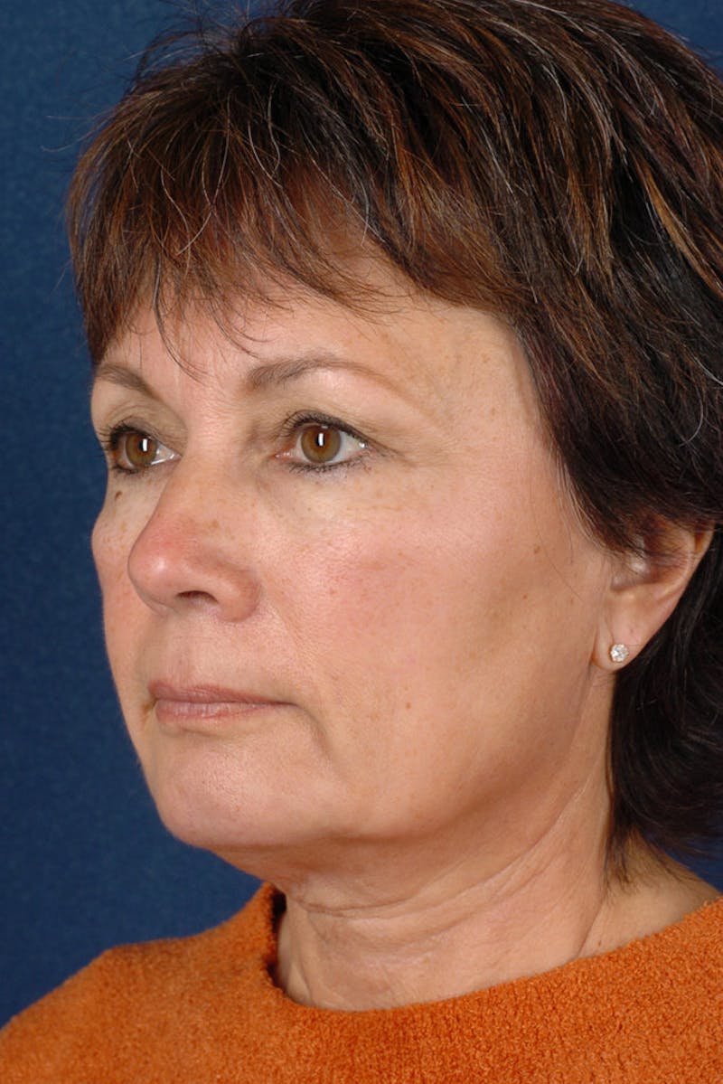 Facelift Before & After Gallery - Patient 9698331 - Image 3