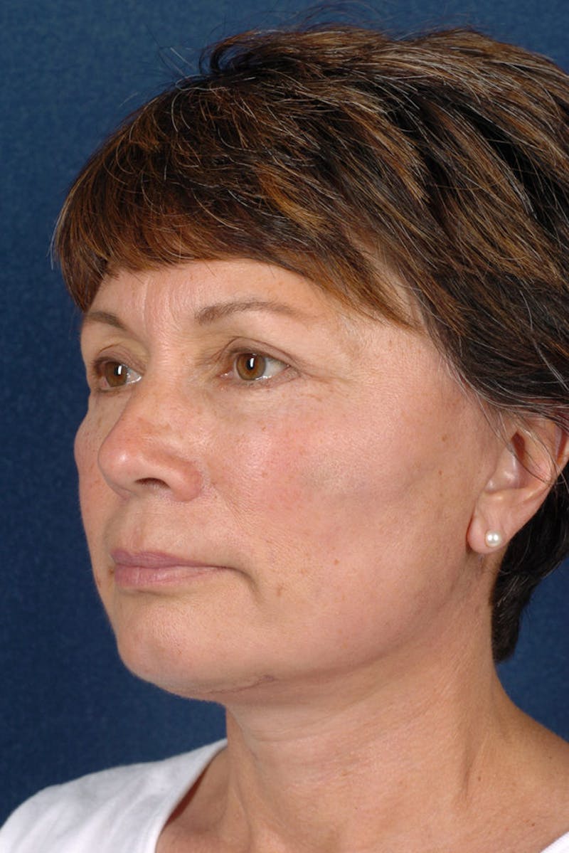 Facelift Before & After Gallery - Patient 9698331 - Image 4
