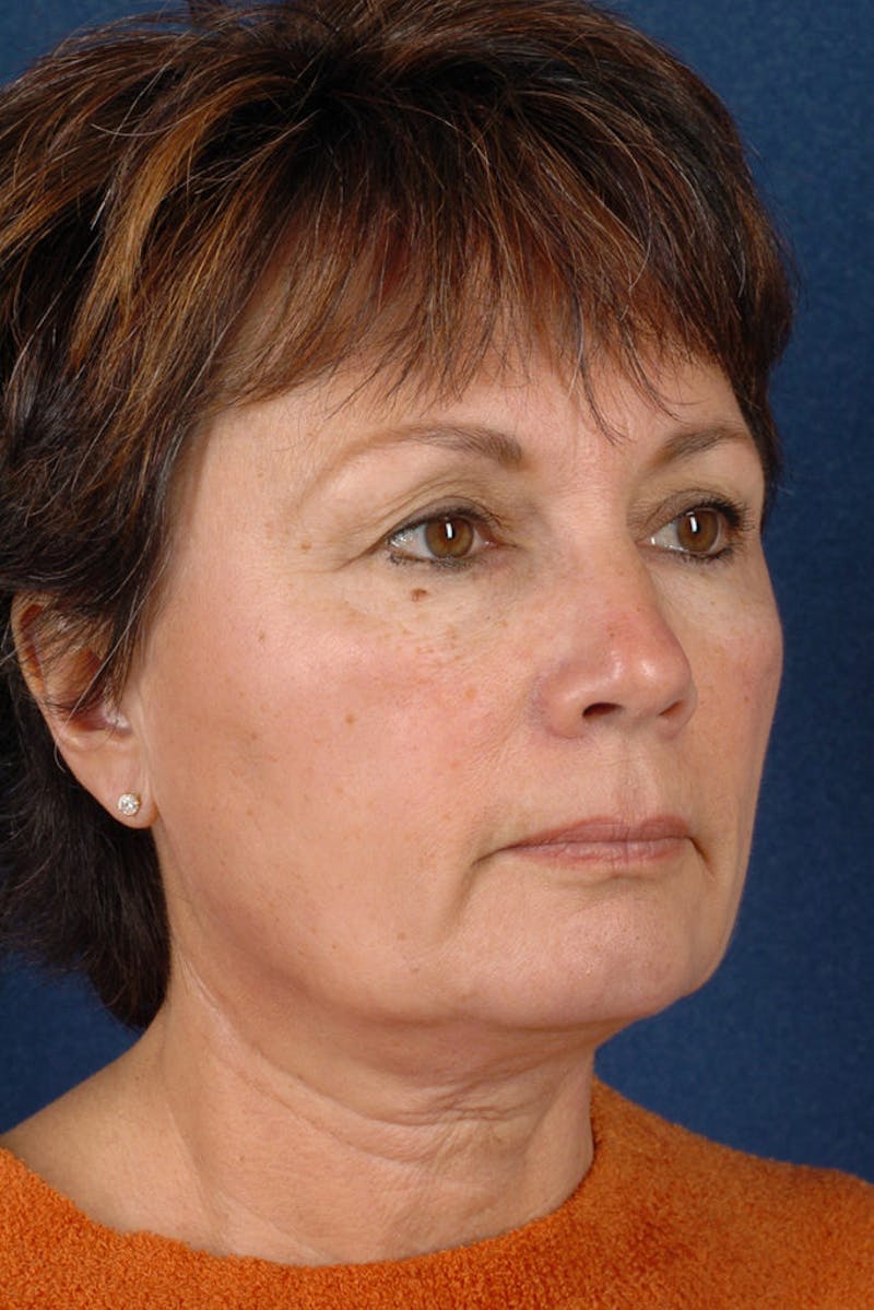 Facelift Before & After Gallery - Patient 9698331 - Image 5
