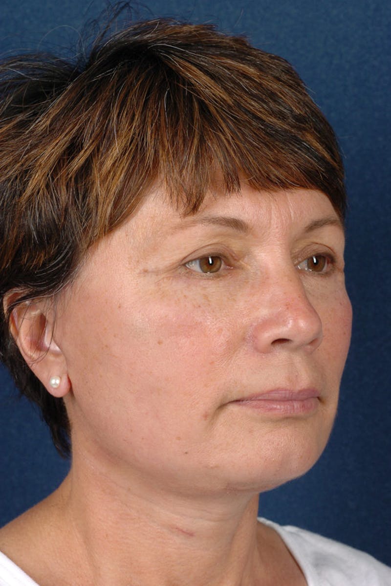 Facelift Before & After Gallery - Patient 9698331 - Image 6