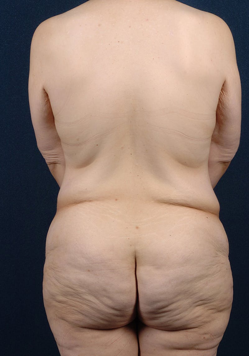 Lower Body Lift Before & After Gallery - Patient 9698332 - Image 7