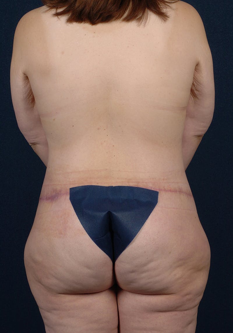 Lower Body Lift Before & After Gallery - Patient 9698332 - Image 8