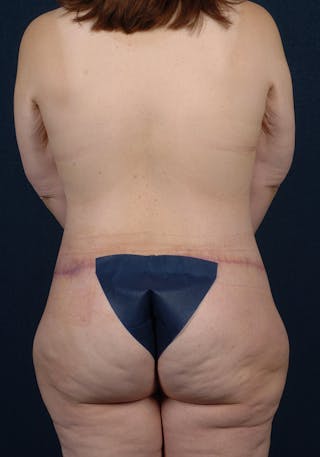 Lower Body Lift Before & After Gallery - Patient 9698332 - Image 8