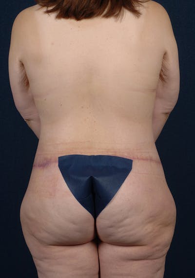 Lower Body Lift Before & After Gallery - Patient 9698332 - Image 8