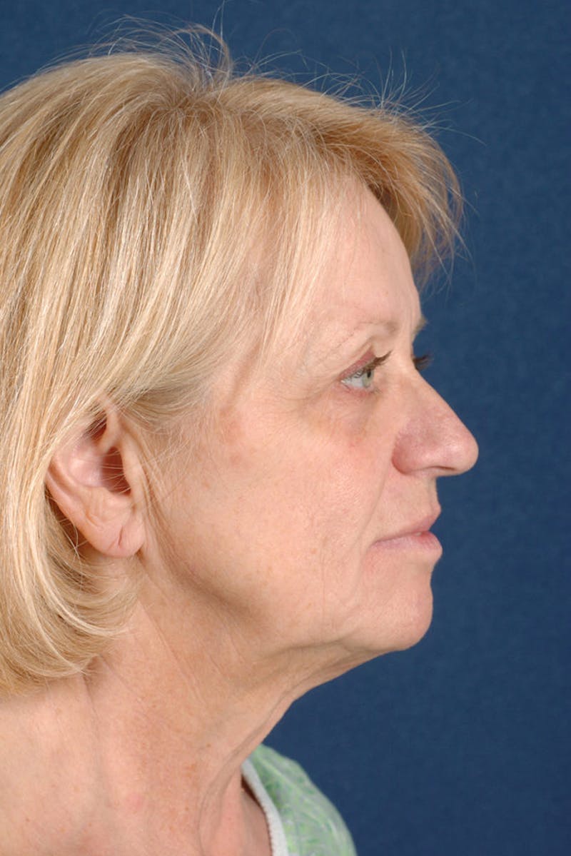 Facelift Before & After Gallery - Patient 9698339 - Image 5
