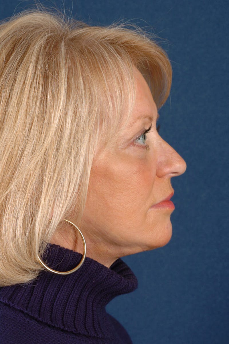 Facelift Before & After Gallery - Patient 9698339 - Image 6