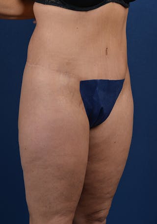 Lower Body Lift Before & After Gallery - Patient 9698343 - Image 6