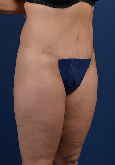 Lower Body Lift Before & After Gallery - Patient 9698343 - Image 6